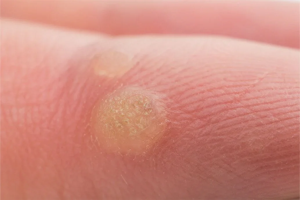 Ojo de gallo (Tiloma) qué es y cómo tratarlo Eucerin